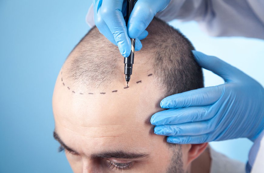 Best Hair Transplant in Gurgaon