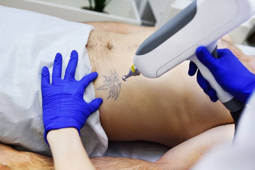 Why You Should Trust Experienced Professionals for Laser Tattoo Removal