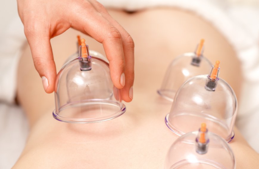 Is Hijama Cupping Therapy the Ultimate Stress Reliever?