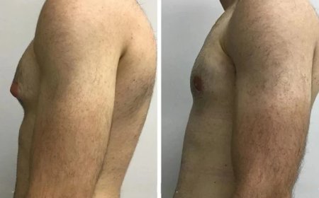 Best Doctors in Dubai for Gynecomastia Offering Safe and Effective Treatment