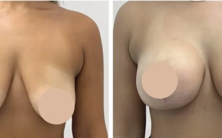 Transformative Experiences with Best Doctors in Dubai Breast Reduction in Dubai