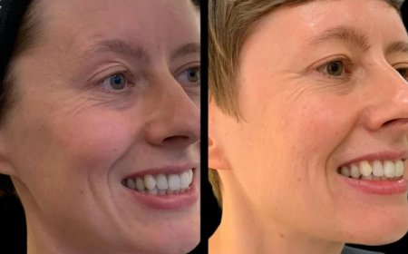 Profhilo Treatment in Dubai for Premium Skin Quality Improvement