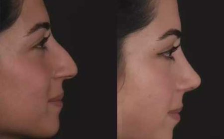 Best Septoplasty Surgeon in Dubai and Airway Stability Goals