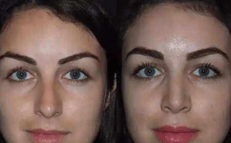 Best Doctors in Dubai for Natural Nose Surgery Results