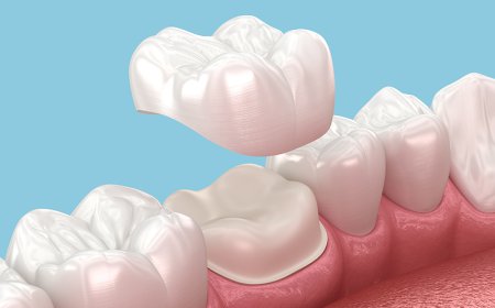 Premium Dental Crowns and Bridges Dubai for Stronger Teeth
