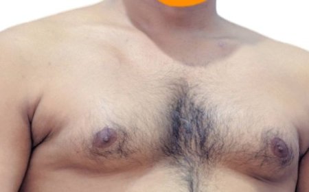 Why Consider Inverted Nipple Surgery Today?