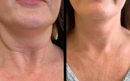 Best Plastic Surgeons in Dubai for Comprehensive Profhilo Treatment