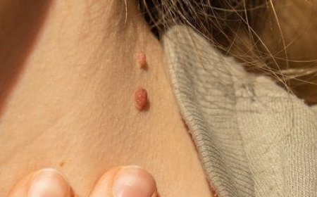 How Is Skin Tag Removal Treatment Performed?