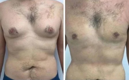 Benefits of Visiting the Best Gynecomastia Surgeon in Dubai