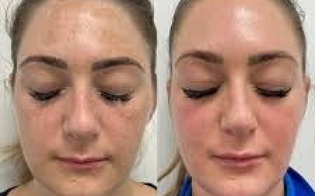 Post-Treatment Skincare Tips After Cosmelan Pigmentation Treatment in Altrincham
