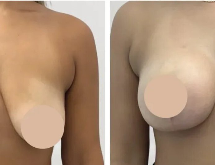 Transformative Experiences with Best Doctors in Dubai Breast Reduction in Dubai