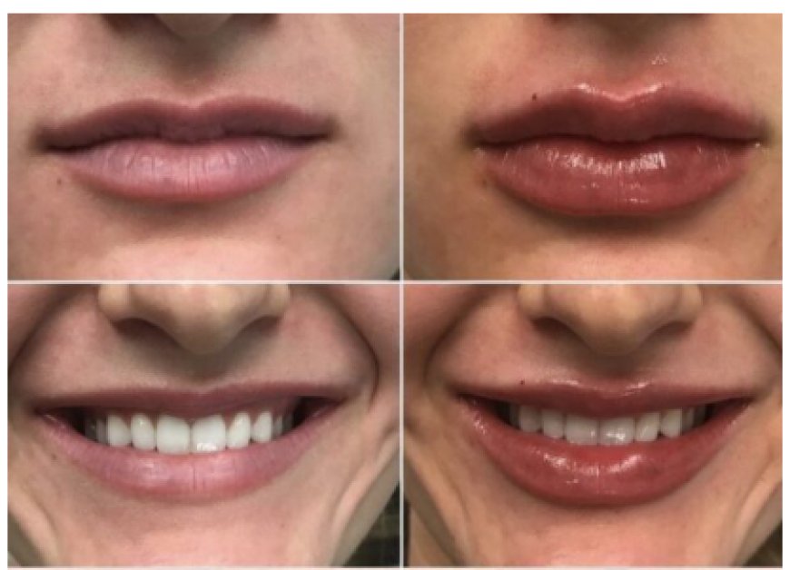 Testosterone Replacement Therapy in Lehigh Valley | Azani