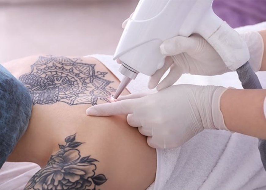 Is Pico Laser Effective for Tattoo Removal?