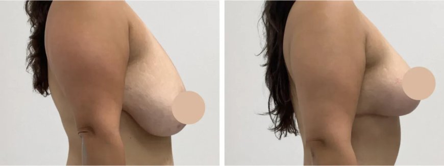 The Future of Breast Lift Care with the Best Doctors in Dubai