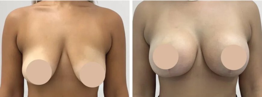 Transformative Experiences with Best Doctors in Dubai Breast Reduction in Dubai