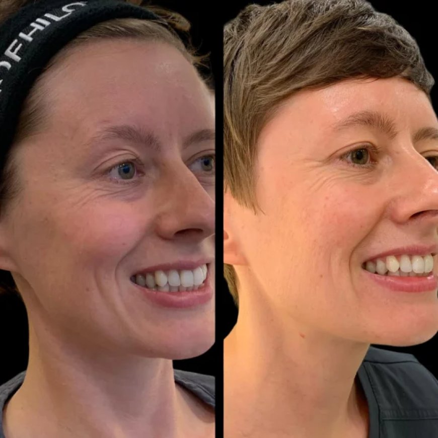 Profhilo Treatment in Dubai for Premium Skin Quality Improvement
