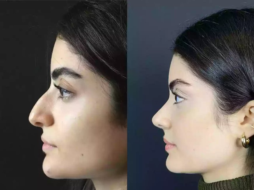 Best Rhinoplasty Surgeon in Dubai: Risk Assessment Standards