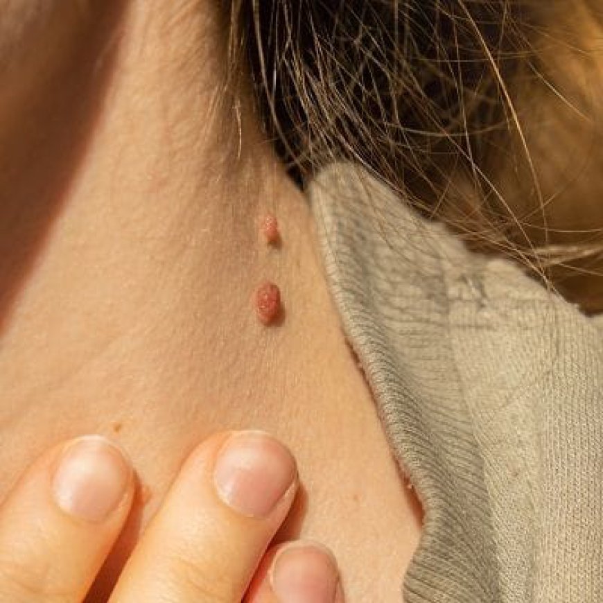 How Does Skin Tag Removal Work?