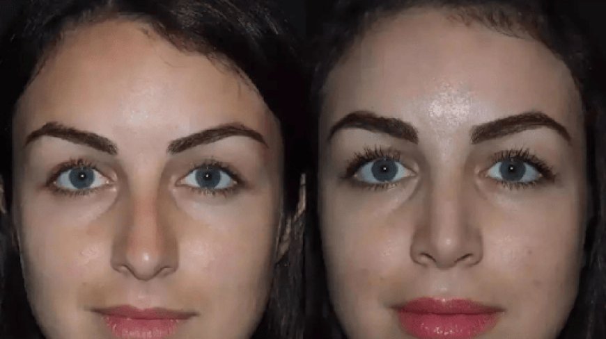 Best Doctors in Dubai for Natural Nose Surgery Results