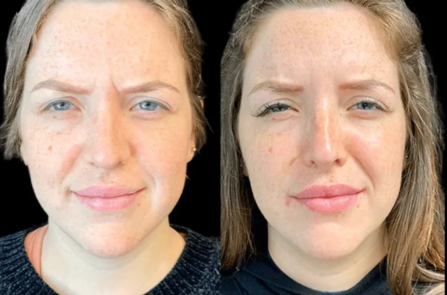 Best Aesthetic Clinic in dubai for Botox for Younger-Looking Skin
