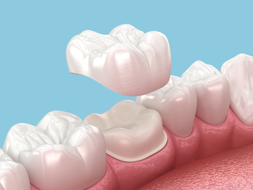 Premium Dental Crowns and Bridges Dubai for Stronger Teeth