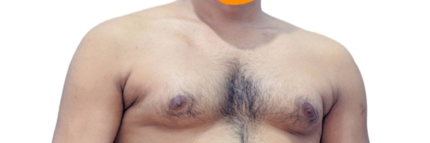Why Consider Inverted Nipple Surgery Today?