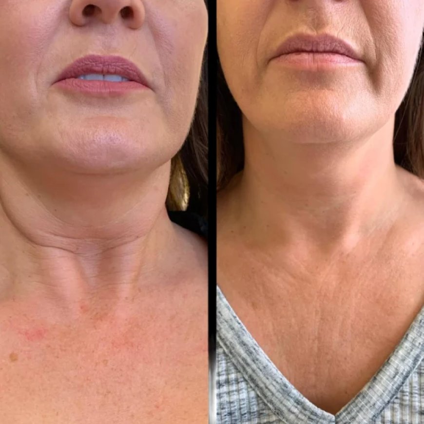 Best Plastic Surgeons in Dubai for Comprehensive Profhilo Treatment