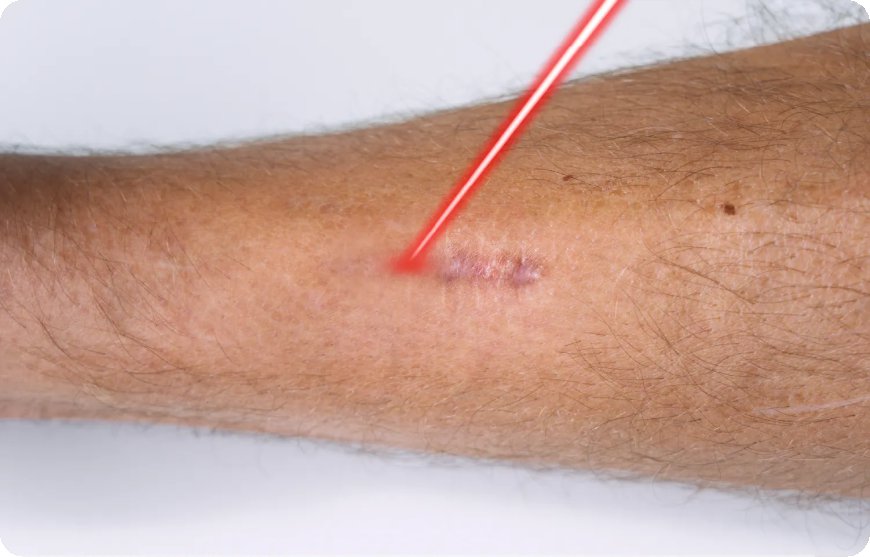 When Is the Right Time to Begin Treatment for Post-Surgical Scars?