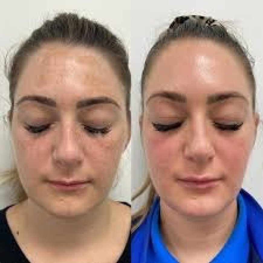 Post-Treatment Skincare Tips After Cosmelan Pigmentation Treatment in Altrincham