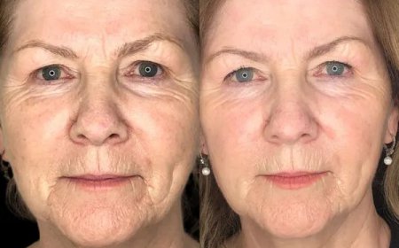 Does Profhilo in Dubai Improve Skin Elasticity?