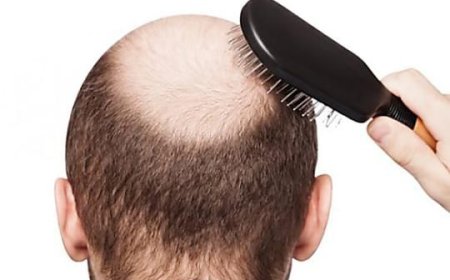 How Can Men Treat Baldness Effectively?