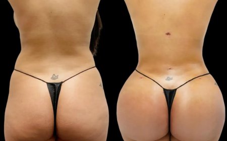 Fat Transfer Surgery in Dubai for Body Contouring
