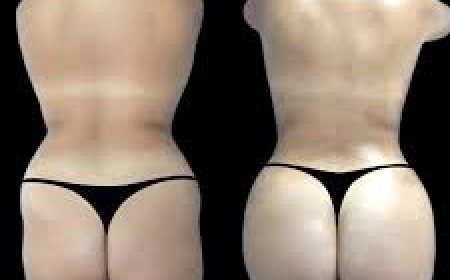 Understanding Fat Grafting in Butt Fat Transfer Surgery in Dubai