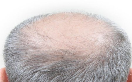 Can Crown Hair Transplant Fix Bald Spots?