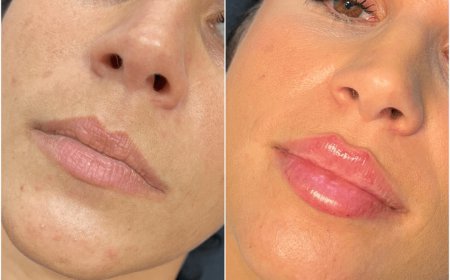 Juvederm for Nasolabial Folds at the Best Aesthetic Clinics in Dubai