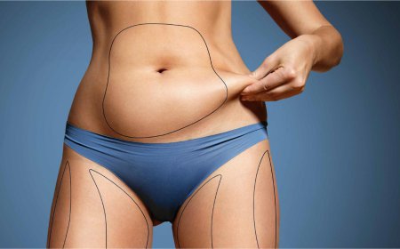 Who Is an Ideal Candidate for Abdominoplasty Dubai?