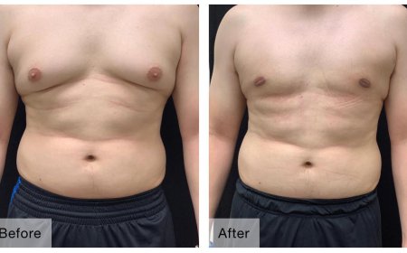 Gynecomastia Surgery: What Every Patient Should Know