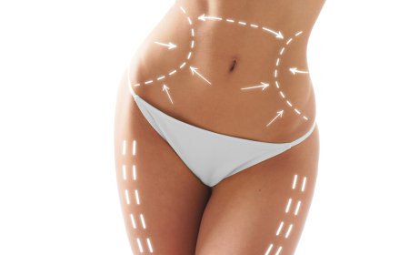 Can Vaser 4D Liposuction Improve Muscle Definition?