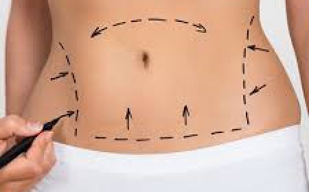 Can Liposuction Remove Stubborn Fat Deposits?