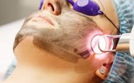 Can the Spectra Carbon Peel Effectively Treat Skin Pigmentation?