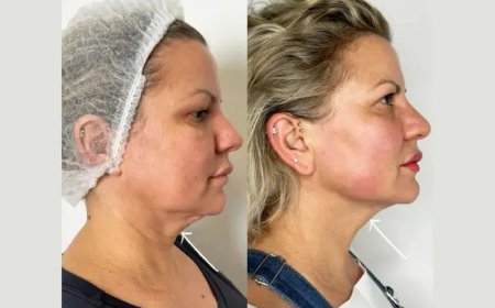 Endolift Treatments in Dubai for advanced non surgical skin tightening