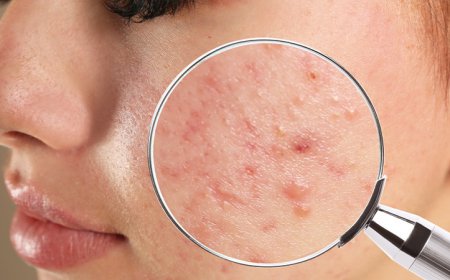 فهم علاج حب الشباب في الرياض: دليل كامل