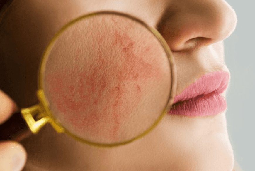 Who Is Considered an Ideal Candidate for Rosacea Treatment?
