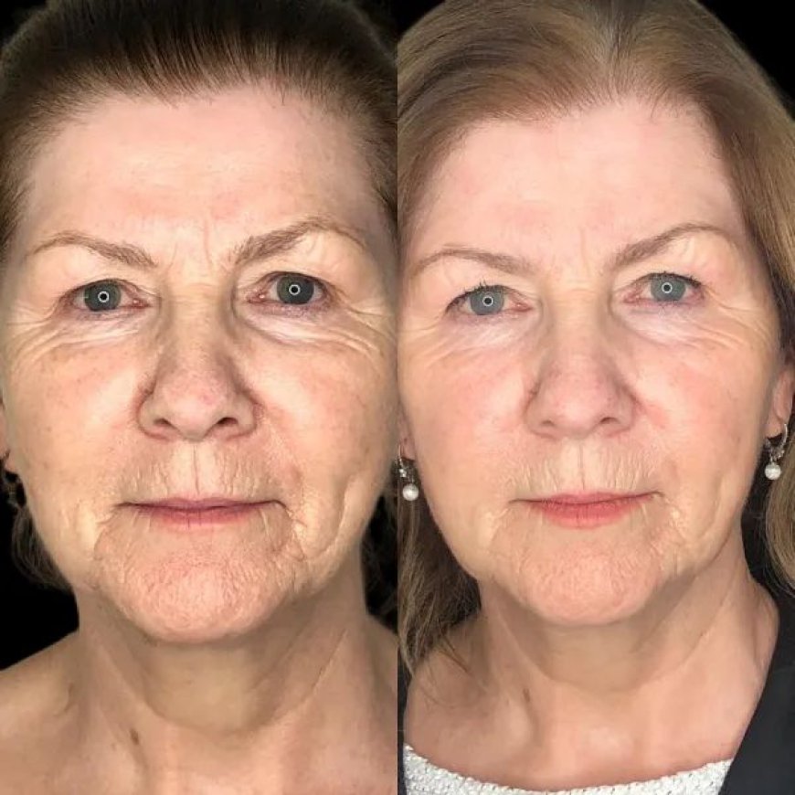 Does Profhilo in Dubai Improve Skin Elasticity?