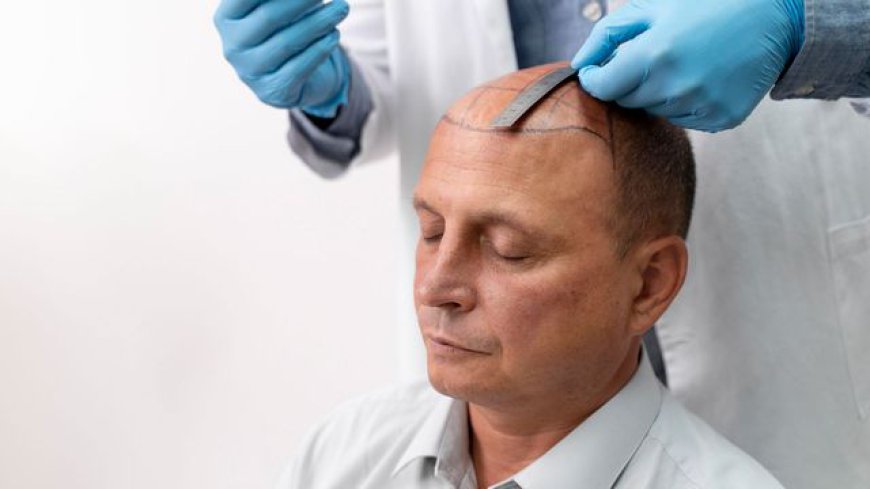 Can Smp Cover Scars From Hair Transplant Surgery?