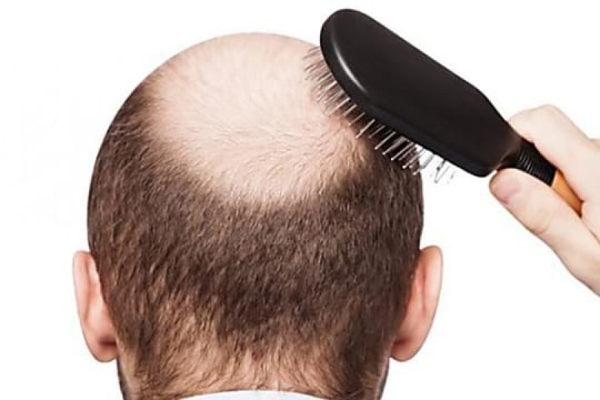How Can Men Treat Baldness Effectively?