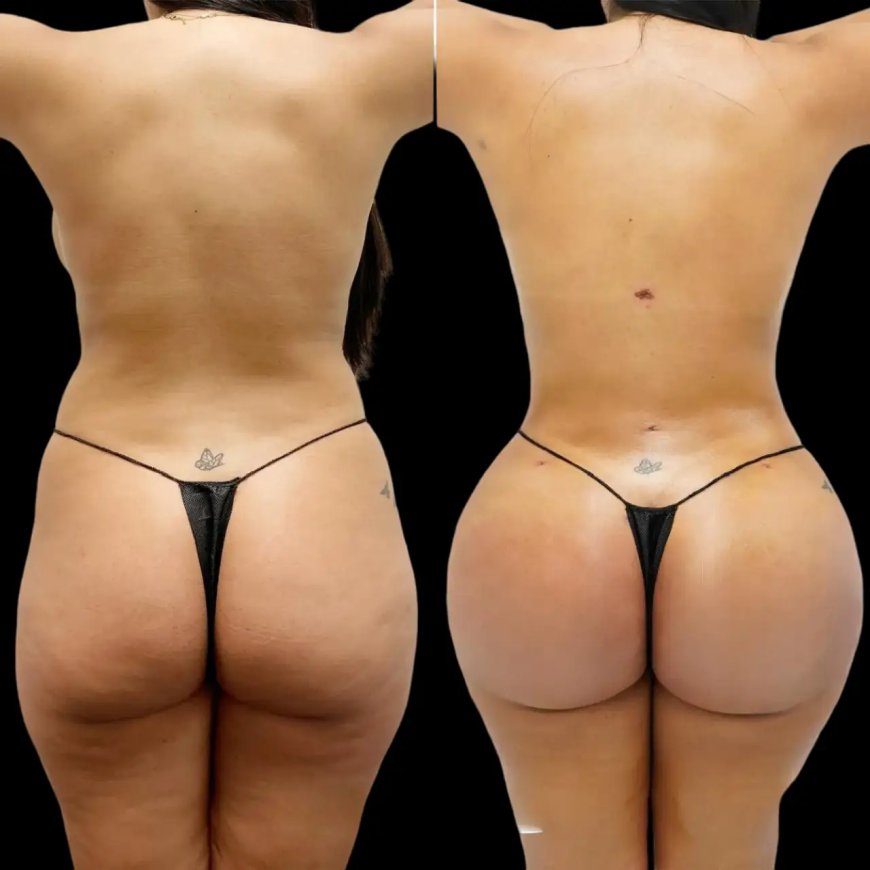 Fat Transfer Surgery in Dubai for Body Contouring