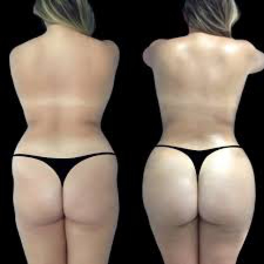 Understanding Fat Grafting in Butt Fat Transfer Surgery in Dubai