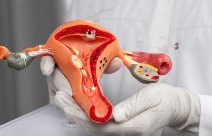 Who Is the Best Candidate for Myomectomy Surgery?