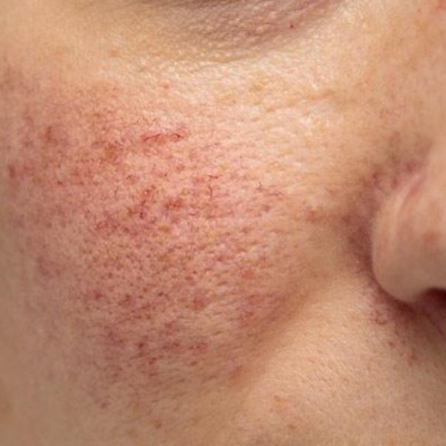 Which Treatments Are Effective for Reducing Rosacea-Related Facial Redness?